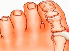 Косточка на ногах: эти 4 натуральных средства эффективно выведут соли и быстро избавят от боли