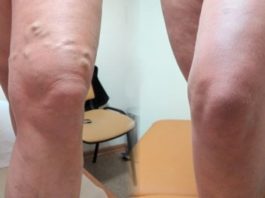 Мазь для лечения узлов на ногах — тромбофлебита и варикоза